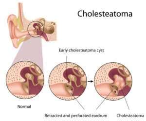 Cholesteatoma | Causes, Signs and Symptoms, Treatment | Dr. Thind