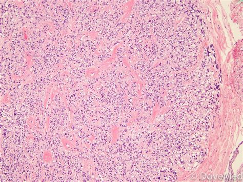 Metaplastic Carcinoma of Breast