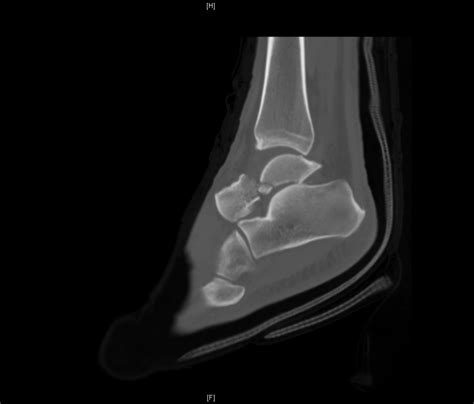 Case Report: Talar Neck Fracture - JETem