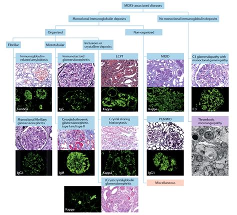 Kidney Biopsy of the Month: Glomerular diseases with organized deposits ...