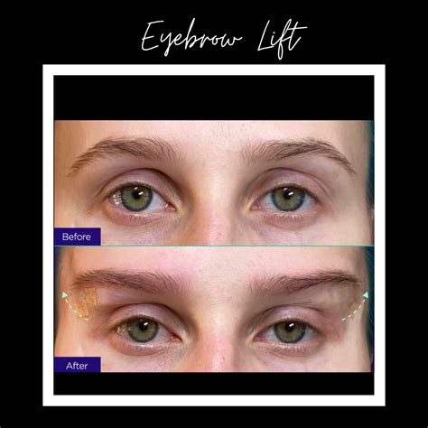 Eyebrow Lift - Before and After Pictures, Info & Prices