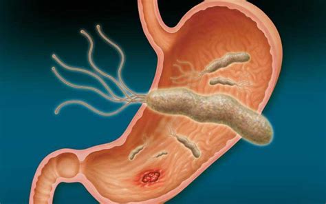 Helicobacter pylori: causas, sintomas y tratamiento de esta bacteria