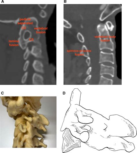 CT image of C2–3 congenital fusion. A Vertebral body fusion and lamina ...