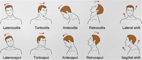 Cervical Dystonia, spasmodic torticollis, CDC