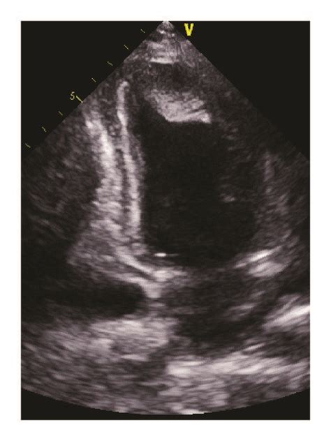 Transthoracic echocardiography showing apical left ventricular thrombus ...