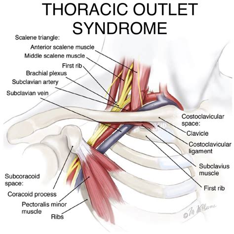 Brachial Plexus Thoracic Outlet Syndrome | Images and Photos finder