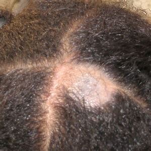 When ringworm causes hair loss in your child | Health24