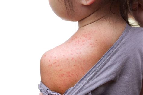 Measles (Rubeola) Causes, Symptoms, Complications and More Information + PlusVitality