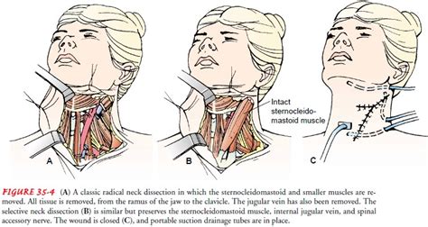 Neck Dissection