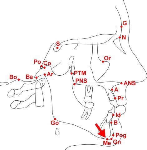 Menton (Me) | Ortodoncia, Aparatos de ortodoncia, Odontología