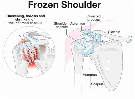 Symptoms, Stages & Treatment for Frozen Shoulder | Learn More