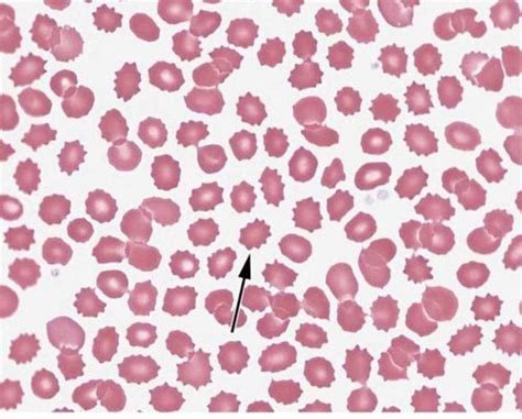 Echinocytes (aka burr cells) in a peripheral blood smear. Note the ...