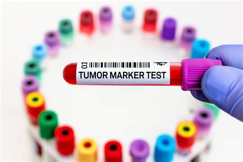 What You (Probably) Didn’t Know About Actionable Biomarkers for NSCLC – Part 2 - Physician's Weekly