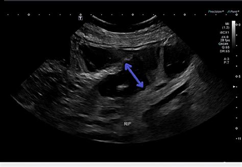 Ultrasound view image demonstrate prominent bowel loops are noted... | Download Scientific Diagram