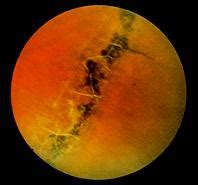 Retinal lattice degeneration - lpukraine