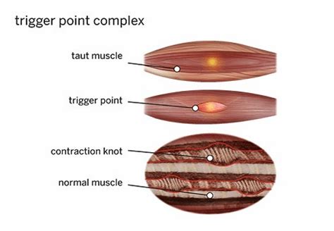 What is Dry Needling and is it for me? | PPS Physiotherapy