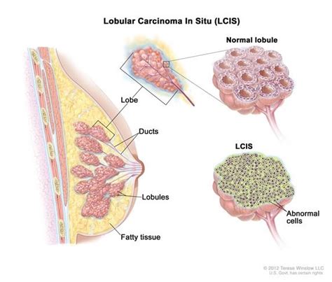 Lobular Carcinoma In Situ (LCIS) Causes, Symptoms, Diangosis and ...