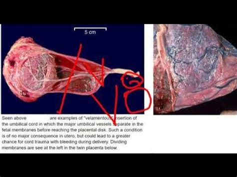 Obstetrics 275 Velamentous insertion of cord placenta Abnormal Vasa Previa - YouTube