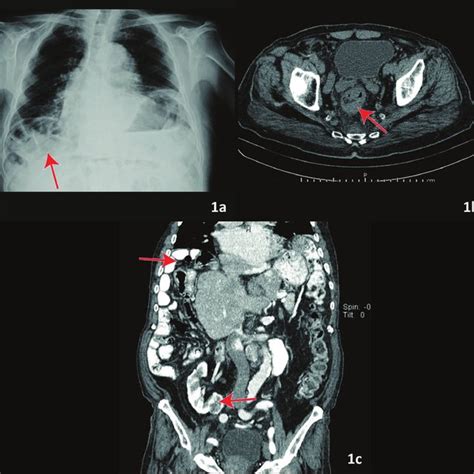 a) On anterior-posterior chest X-ray, the elevation of the right ...