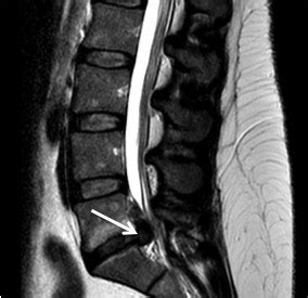 Lumbar Disc Protrusions - 'Sciatica' - Sydney Neurospine