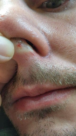 I have never had an ingrown nose hair before. Got a few pops over 2 days then noticed a black ...