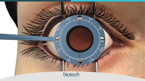 Eyecryl TORIC Range Axis Marking & Implantation Guide - YouTube