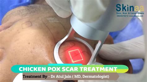 How to remove Chicken Pox Scars from Face and Body by Laser Treatment at Skinaa, Jaipur - YouTube