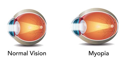 AI-Powered Myopia Control Lenses Market Driven By Rising