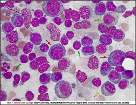 Lymphoplasmacytic lymphoma - CELL - Atlas of Haematological Cytology