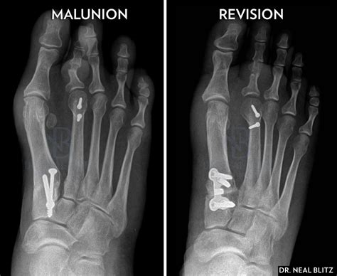 Addressing Common Complications Of The Lapidus Bunionectomy