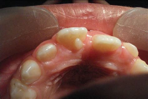 What is talon cusp and dens evaginatus? | News | Dentagama