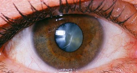 What Causes Halos Around Lights After Cataract Surgery | Shelly Lighting