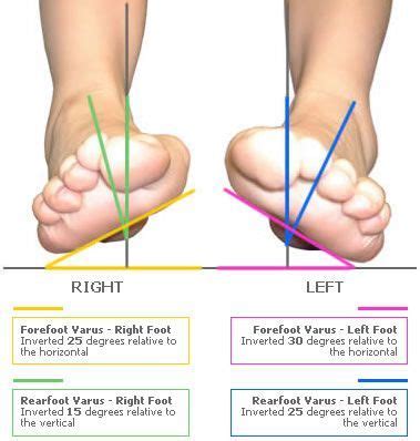 Foot shape assessment example shown identifies severe bilateral forefoot and rearfoot varus ...