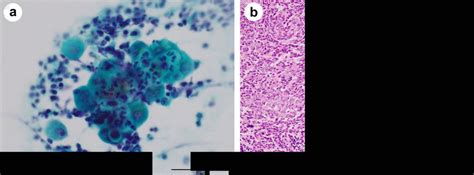 Cytology of pericardial fluid (Papanicolaou stain, × 400) (a) and ...