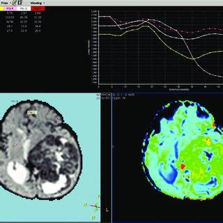 MRI brain perfusion image showing excessive vascularity of the tumor ...