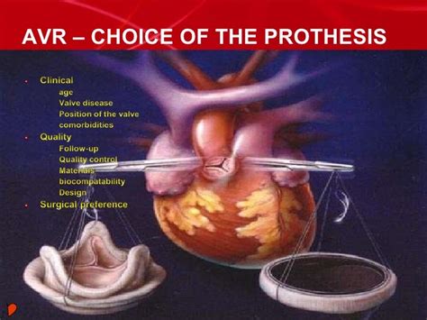 Aortic Stenosis Surgery