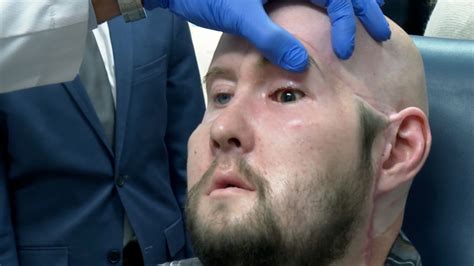 History made as man receives the world’s first whole-eye transplant ...