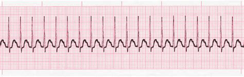 ACLS Cardiac Arrhythmia Quiz #12