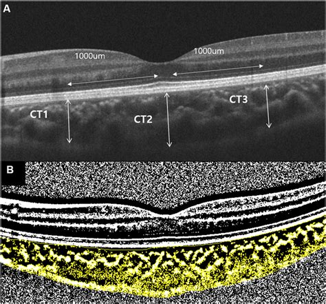 Measurements of choroidal thickness and vascularity. (A) Nasal ...