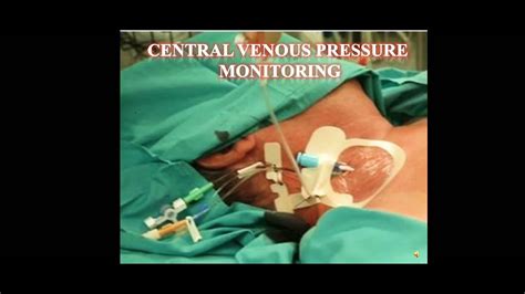 Central Venous Pressure Monitoring Procedure||CVP - YouTube