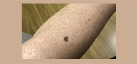 Melanoma in Situ – What is it and How did it affect me?