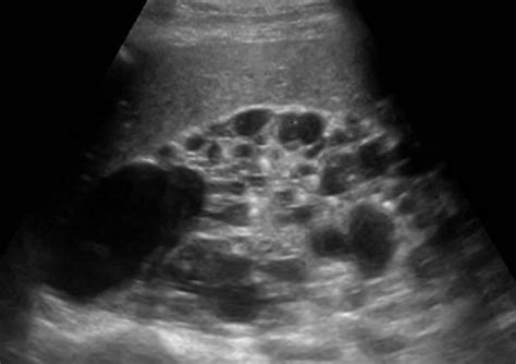 Urinary Tract and male reproductive system | 2.1 Kidney and ureter : Case 2.1.4 Polycystic ...