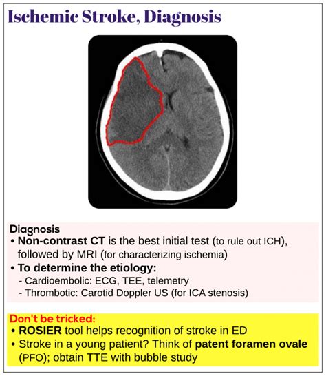 Ischemic stroke, diagnosis - Medicine Keys for MRCPs