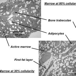 Histology slides of normal human bone marrow at 2 different marrow... | Download Scientific Diagram