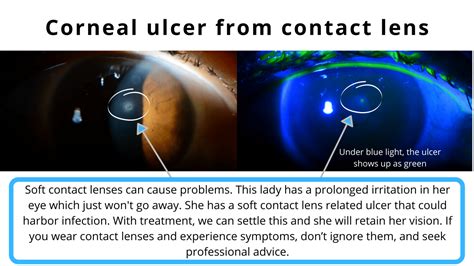 Corneal Erosion – Corneal Surgery