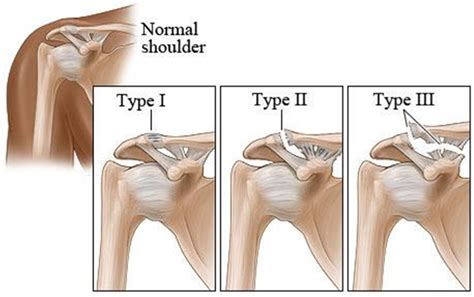 AC Joint Separation | Brisbane Knee and Shoulder Clinic | Dr ...