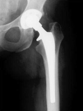 Hip Replacement Imaging: Practice Essentials, Radiography, Computed Tomography