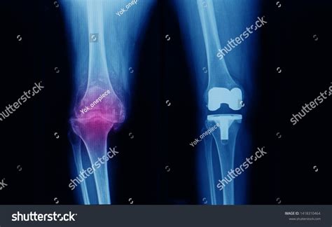 Xray Knee Showing Severe Osteoarthritis Varus Stock Photo (Edit Now ...