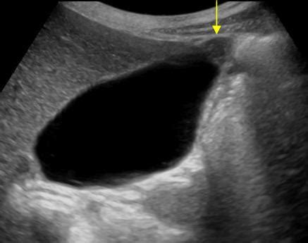 Abdomen and retroperitoneum | 1.2 Gallbladder and bile ducts : Case 1.2 ...