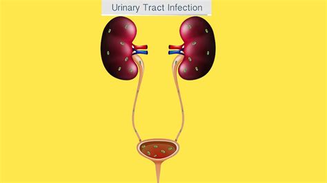 Can UTI Cause Death? – NutritionFact.in